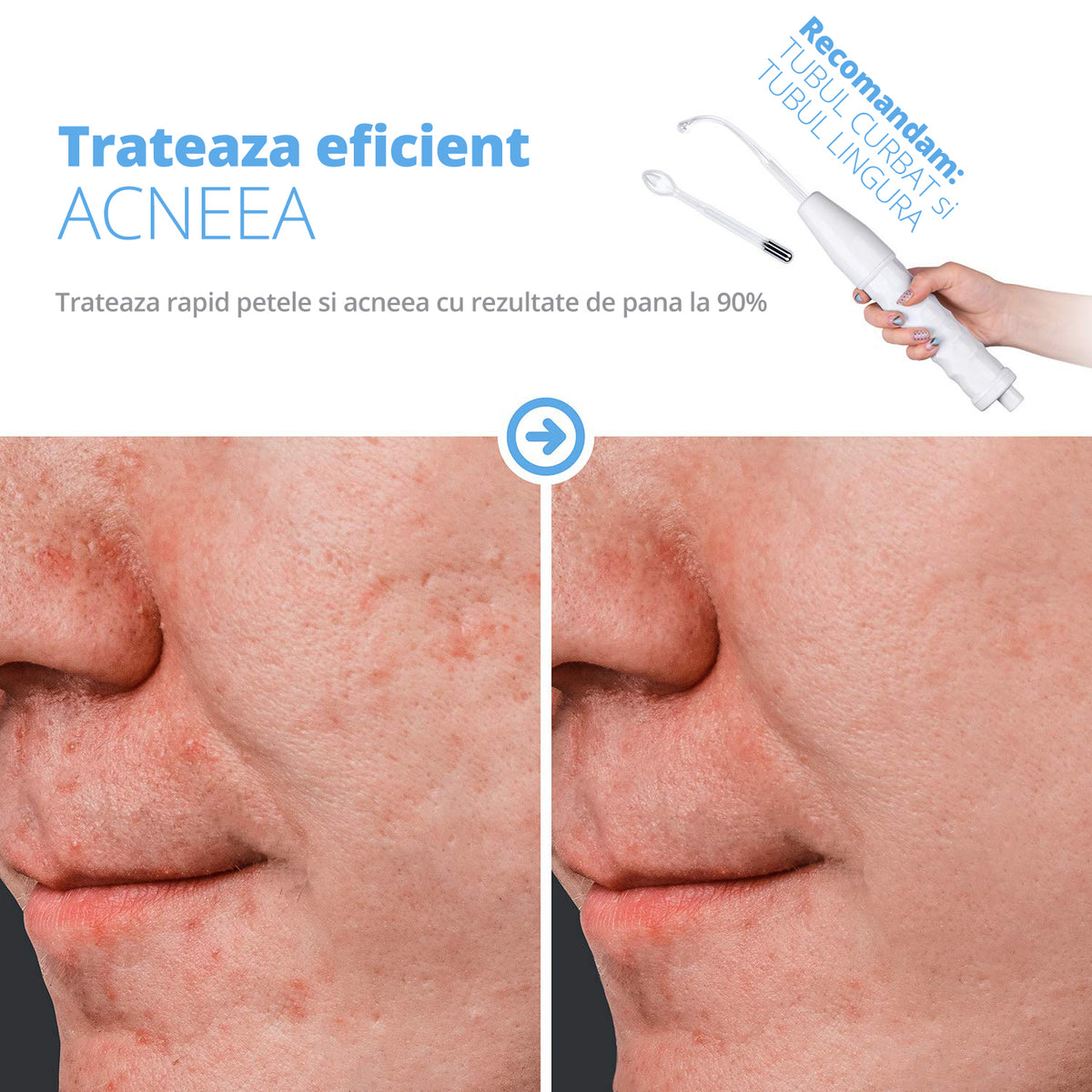 Electroderm, LittleDomi, Tratament cu Neon si Argon pentru Acnee, Riduri, Controlul Petelor, Cearcane, Ten, Par Seboreic, Stimulator Scalp, Infrumusetare, Biostimulare Faciala, Lifting — LD-426 fotografie 8