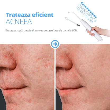Electroderm, LittleDomi, Tratament cu Neon si Argon pentru Acnee, Riduri, Controlul Petelor, Cearcane, Ten, Par Seboreic, Stimulator Scalp, Infrumusetare, Biostimulare Faciala, Lifting — LD-426 fotografie 8
